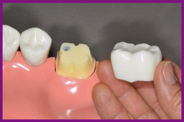 bọc thêm mão sứ làm tăng chi phí điều trị viêm tủy răng