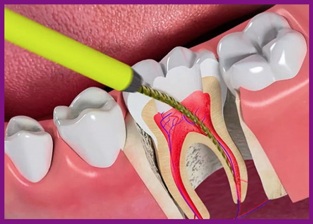 điều trị tủy răng thành công nhờ dụng cụ nội nha