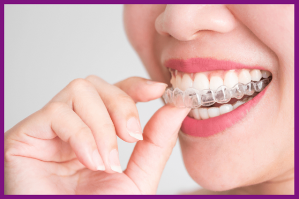 niềng răng invisalign thích hợp để chữa răng hô nhẹ không cần niềng