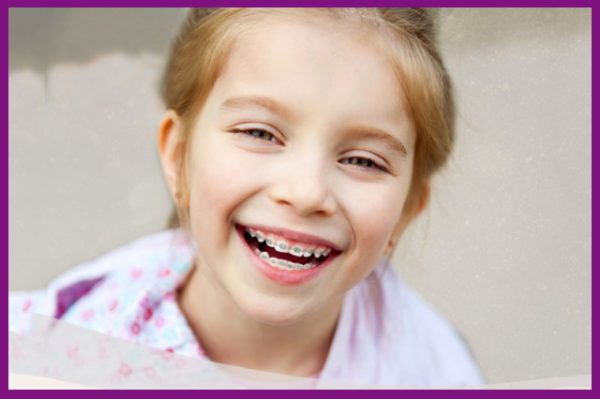 niềng răng xong sẽ giúp trẻ có một hàm răng đều đẹp