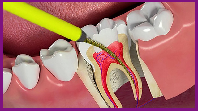 Lây tủy răng ảnh hưởng đến sức khỏe không?