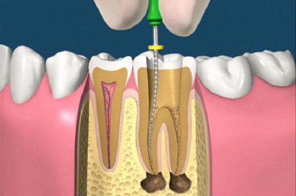 lấy tủy răng có đau không