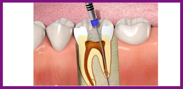 quy trình trám răng lấy tủy