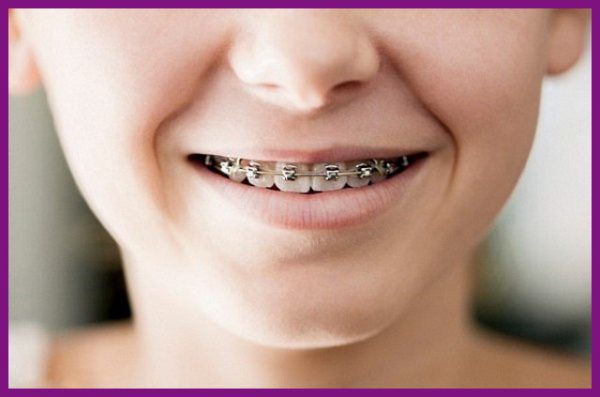 niềng răng mắc cài là loại niềng răng phổ biển cho trẻ