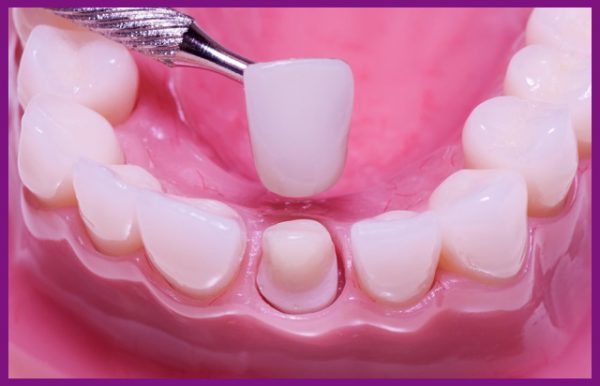bọc răng sứ bắt buộc phải mài mô răng thật, gây tổn hại chân răng