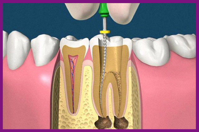 thiết bị nội nha sẽ hỗ trợ làm sạch sâu các chất bẩn bên trong tủy răng