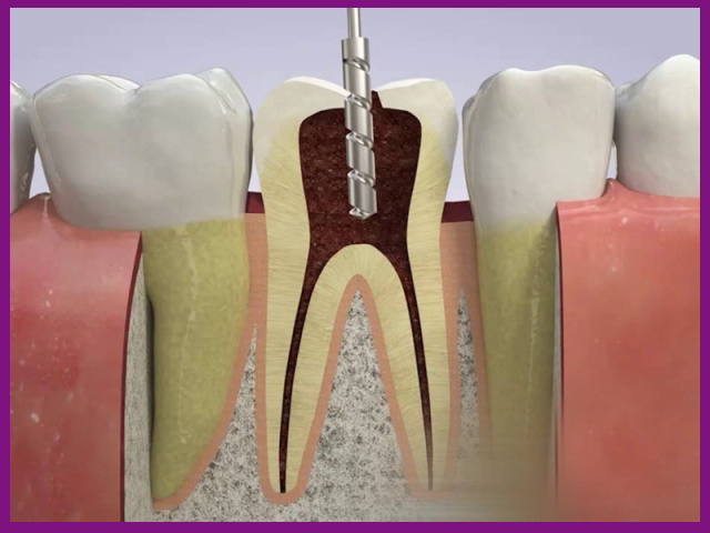 điều trị tủy răng thành công nhờ thiết bị nội nha cầm tay