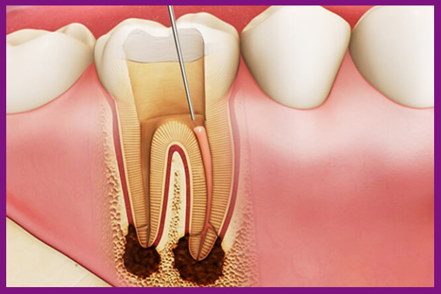 điều trị nội nha là chuyên ngành thăm khám và phát hiện những dấu hiệu bất thường của tủy răng