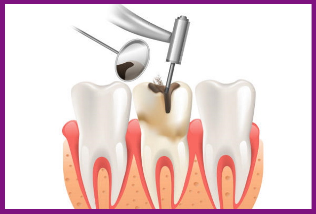 điều trị tủy răng thành công nhờ thiết bị nội nha morita