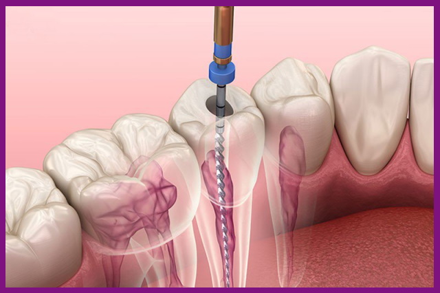 sử dụng thiết bị nha khoa sẽ hỗ trợ việc lấy tủy răng nhanh hơn