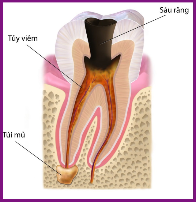 điều trị tủy răng rất khó thực hiện nếu có sự giúp sức của máy nội nha woodpecker