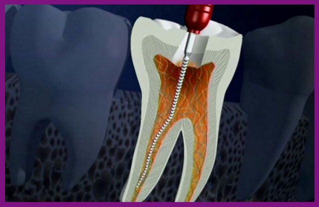 điều trị tủy răng thành công cần sự hỗ trợ rất lớn từ các thiết bị y khoa hiện đại