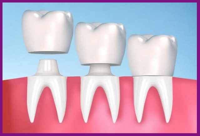 bọc răng sứ sẽ tăng thêm chi phí điều trị viêm tủy răng