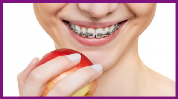 niềng răng 1 hàm giúp khắc phục các vấn đề ăn nhai, cắn xé
