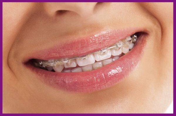 niềng răng có thể sử dụng cho răng bị hô 1 hàm
