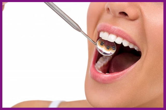 mắc cài trong hầu như chỉnh răng được cho hầu hết mọi đối tượng