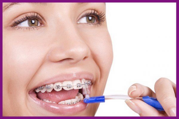 vệ sinh các kẽ hở của răng bằng bàn chải kẽ răng