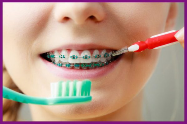 niềng răng giúp rẻ dễ dàng vệ sinh răng miệng hơn