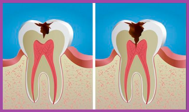 quy trình chữa tủy răng nha khoa