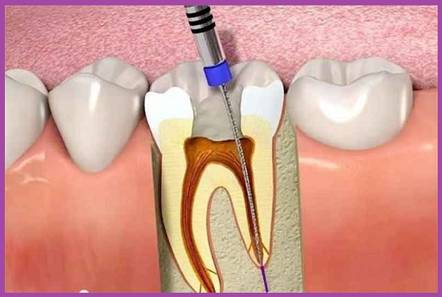 quy trình chữa tủy răng nội nha