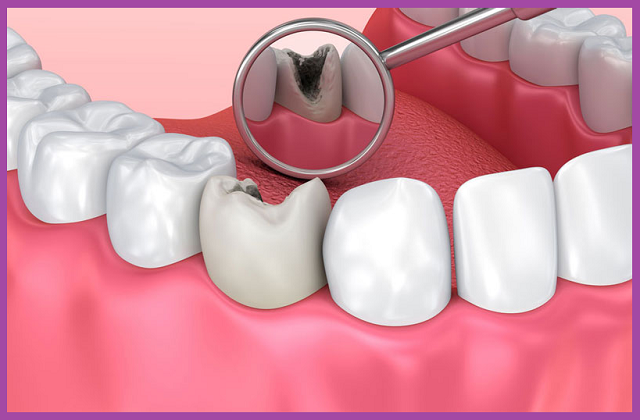 quy trình chữa tủy răng phù hợp