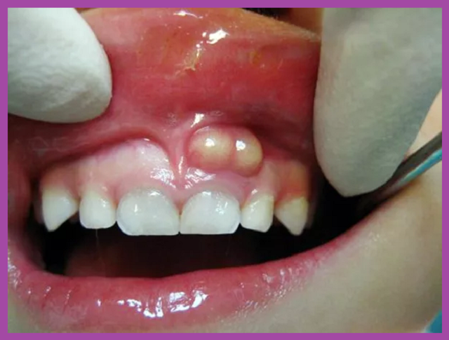 quy trình chữa viêm tủy răng an toàn
