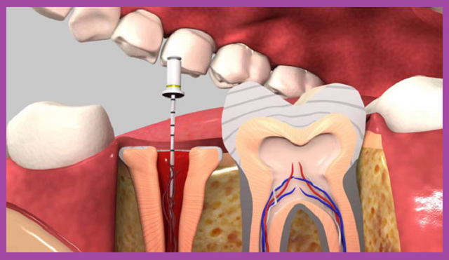 quy trình chữa viêm tủy răng hiệu quả