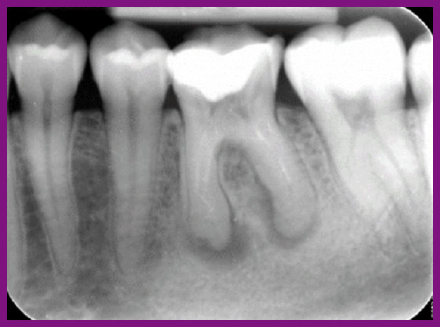 quy trình diệt tuỷ răng có nhanh không