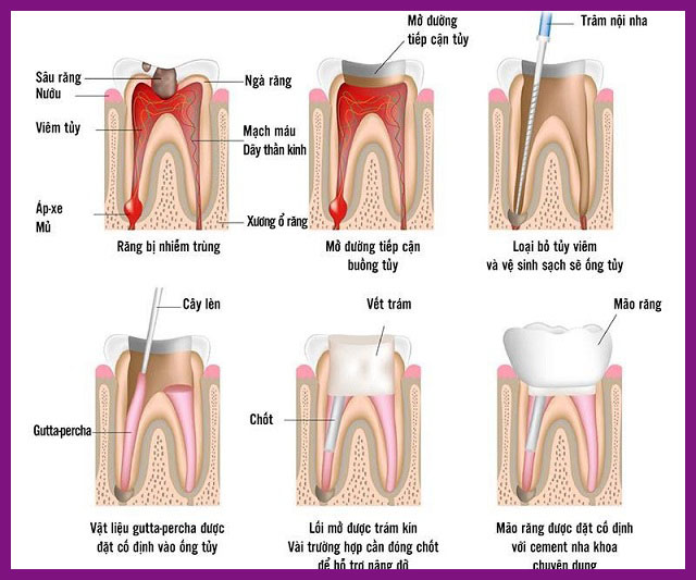 quy trình diệt tuỷ răng tại nha khoa nụ cười sài gòn