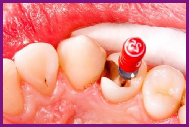 quy trình diệt tuỷ răng tphcm