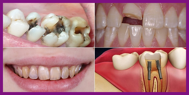 quy trình kỹ thuật điều trị tuỷ răng khó không