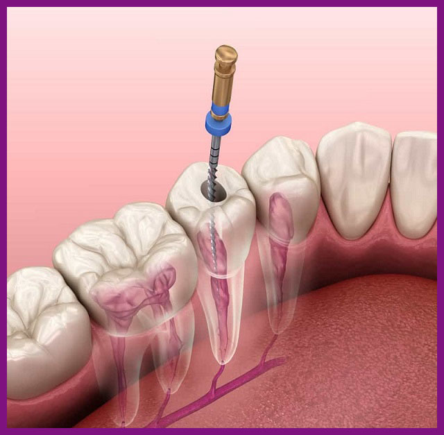 quy trình kỹ thuật điều trị tuỷ răng lâu không