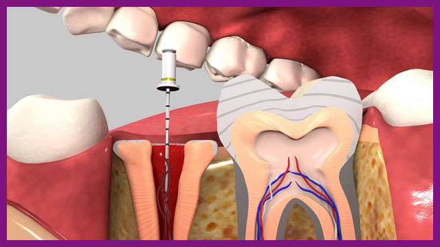 quy trình kỹ thuật điều trị tuỷ răng như thế nào