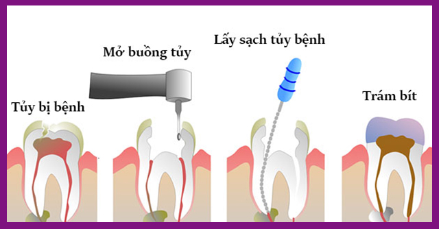 Quy trình lấy tủy răng