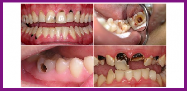 quy trình trám răng bằng composite