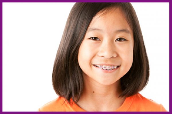 thời điểm thích hợp để niềng răng cho trẻ là từ 12 đến 16 tuổi