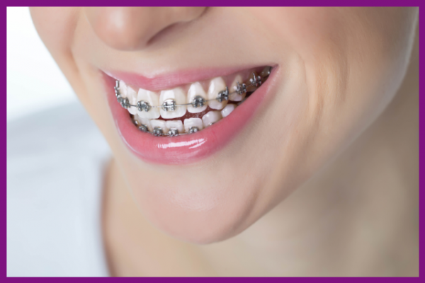 niềng răng là phương pháp mang lại hiệu quả chỉnh nha cao nhất hiện nay