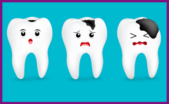 sâu răng là một trong những nguyên nhân khiến trẻ bị viêm tủy răng