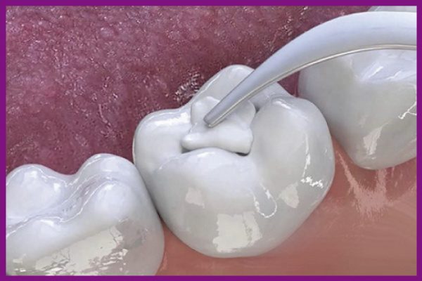 trám răng sau điều trị viêm tủy răng sẽ giúp ngăn chặn vi khuẩn bên ngoài xâm nhập vào