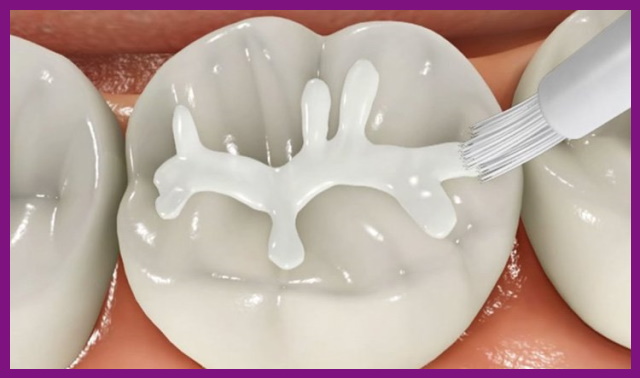 trám răng sẽ giúp ngăn chặn viêm tủy răng tái phát trở lại