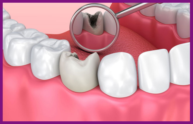 tủy răng bị viêm nên cần được điều trị sớm để ngăn những biến chứng tệ hơn
