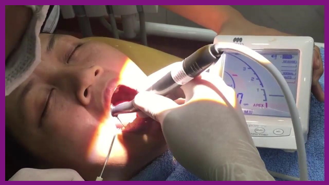 Nha khoa Sài Gòn XO ứng dụng thiết bị nội nha morita trong điều trị