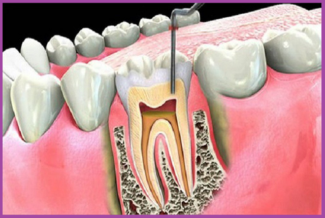 viêm tủy răng có nguy hiểm giải đáp