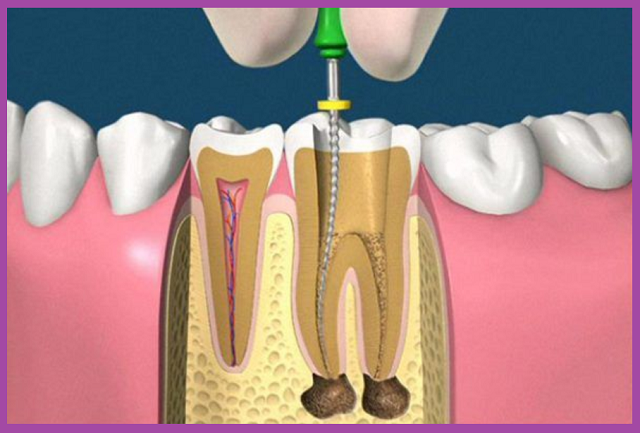 giải đáp viêm tủy răng có nguy hiểm