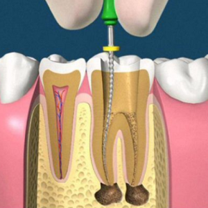 Viêm tủy răng có nguy hiểm không?