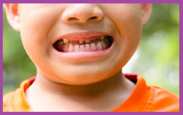 viêm tủy răng ở trẻ em do sâu răng