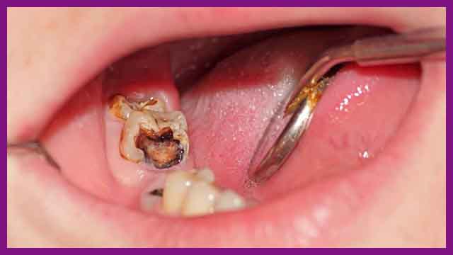 bệnh viêm tuỷ răng
