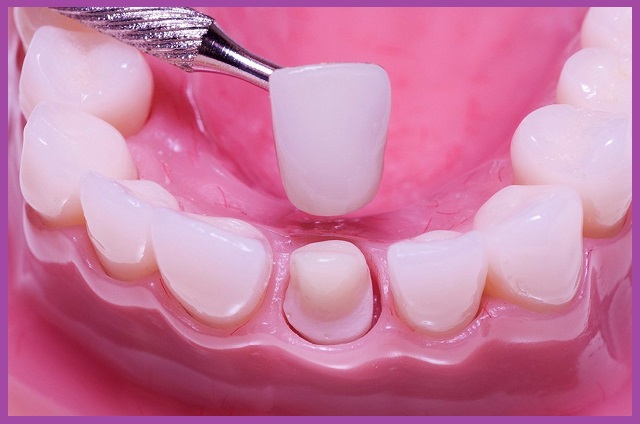 các loại phục hình răng cố định
