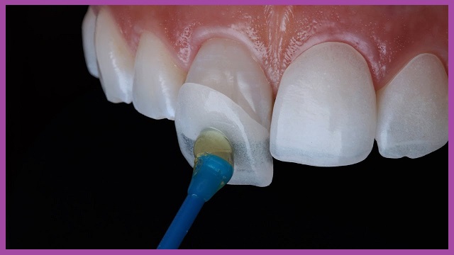 các loại phục hình răng tại tphcm