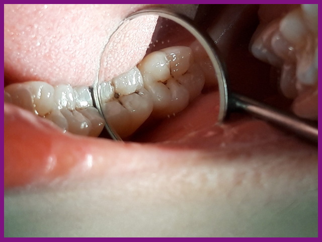 nhận thấy những dấu hiệu của sâu răng cần phải đến nha khoa để điều trị sớm